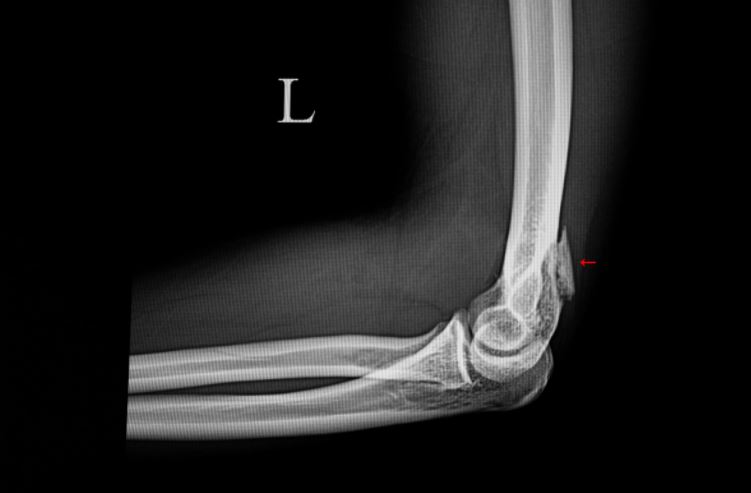 All You Need to Know About Fractured Elbow Treatments in Singapore