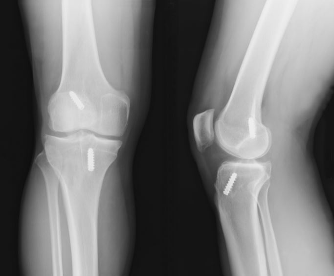 ACL tear x-ray scans